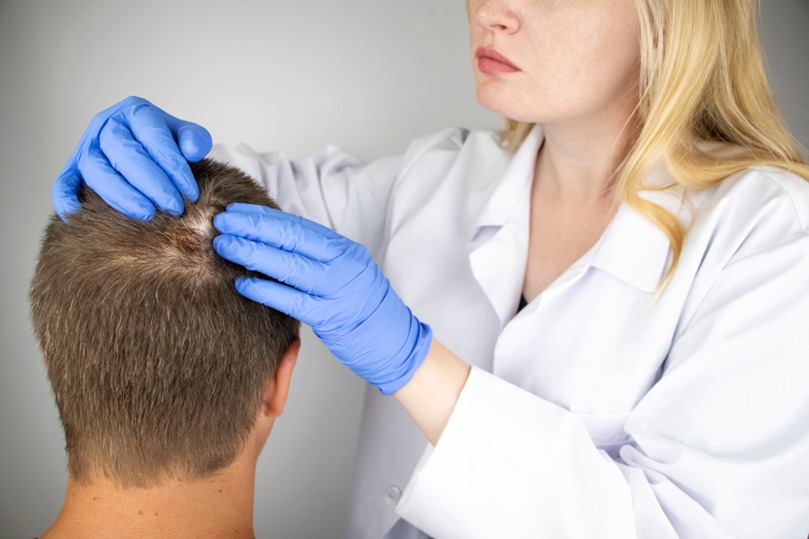 Alopecia