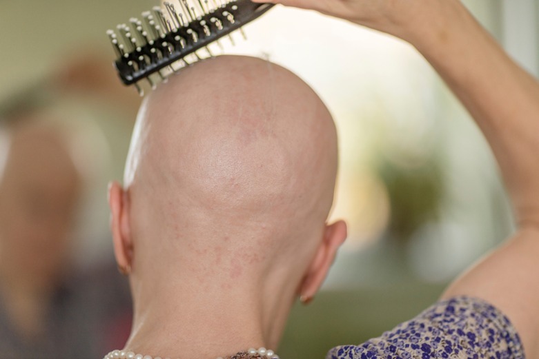 Alopecia