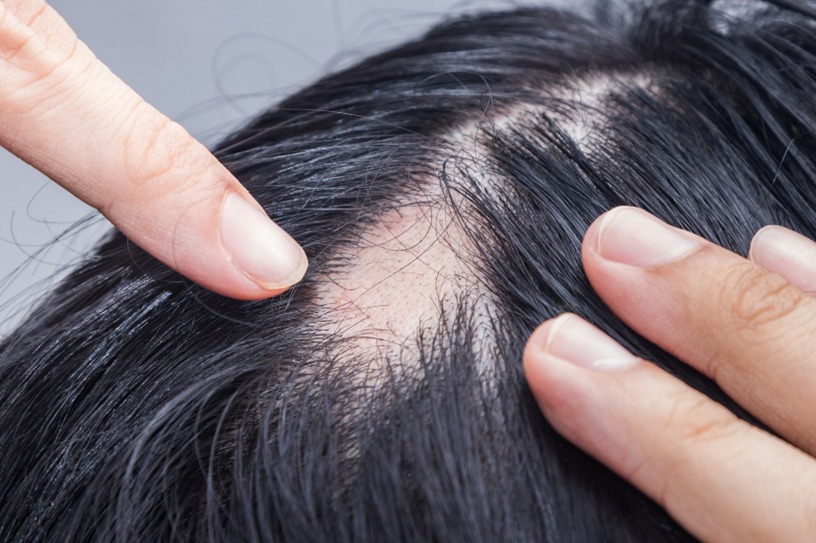 Alopecia